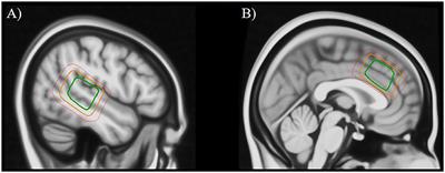 Glutamate- and GABA-Modulated Connectivity in Auditory Hallucinations—A Combined Resting State fMRI and MR Spectroscopy Study